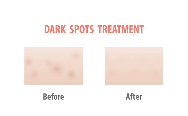 Dark spots treatment comparison illustration vector on white background. Skin concept.