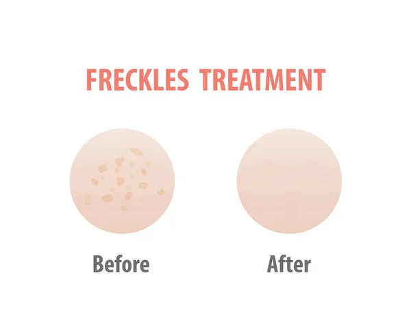 Freckles Tratamento Comparação Ilustração Vetor Fundo Branco Conceito Pele — Vetor de Stock