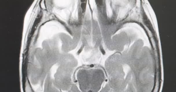 MRI beyin tarama, manyetik rezonans görüntüsü — Stok video