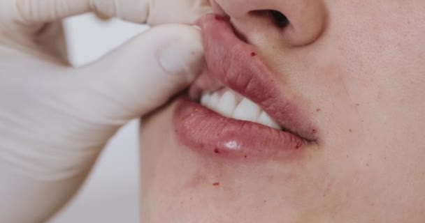 Lip vergroting, close-up. De arts schoonheidsspecialist maakt lip vergroting procedure van een mooie vrouw in een schoonheidssalon. Cosmetische schoonheid injectie concept — Stockvideo