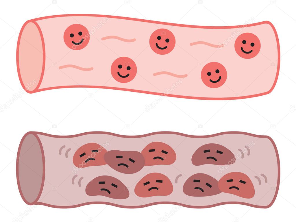 healthy blood vessel and clogged artery in cute characters. health care concept