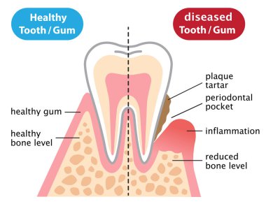 sağlıklı ve inflamatuar hastalıklı sakız. Diş ve sağlık kavramı