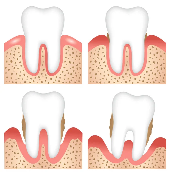 Fasi Della Malattia Gengivale Illustrazione Infografica Concetto Cura Dentale Orale — Vettoriale Stock