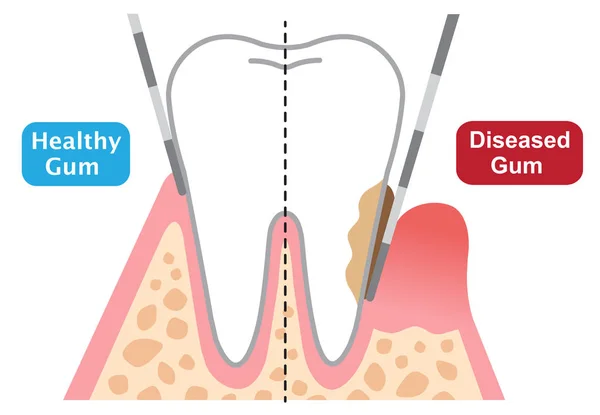 sağlıklı ve hastalıklı dişeti gösterilen periodontal problama derinliği. Diş ve sağlık kavramı