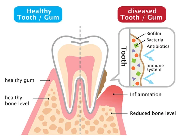 健康和疾病的口香糖 口服生物膜 牙科和保健概念 — 图库矢量图片