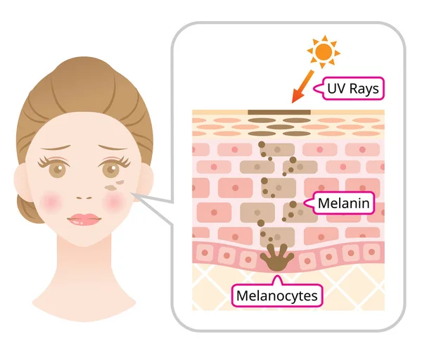 黑色素和面部黑斑的皮肤机制 女性面部和皮肤层的信息图 美容护肤理念 — 图库矢量图片