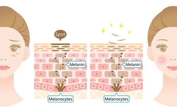 Mechanismus Obratu Kožní Buňky Melanin Melanocyty Lidské Kůži Ženskou Tváří — Stockový vektor