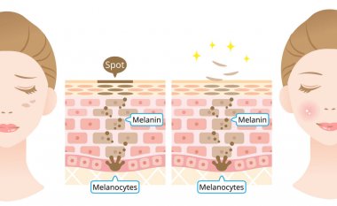 infografik deri hücre ciro illüstrasyon. Melanin ve melanositler insan deri tabakasında kadın yüzü ile. güzellik ve cilt bakım konsepti