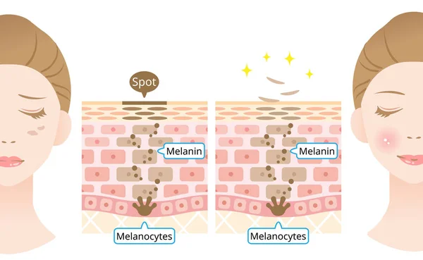 Infografía Ilustración Del Recambio Celular Piel Melanina Melanocitos Capa Piel — Archivo Imágenes Vectoriales