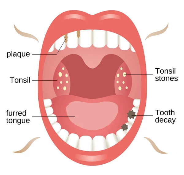 Boca Aliento Fresco Ilustración Concepto Atención Oral Sanitaria — Vector de stock