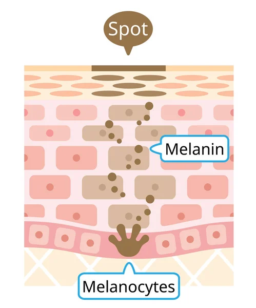 Camada Pele Humana Melanina Manchas Escuras Faciais Ilustração Camada Pele —  Vetores de Stock