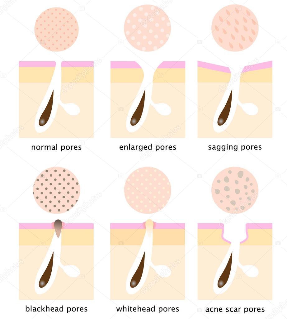 skin surface and inner structure around pores, normal, sagging, open , blackhead, whitehead, and acne scar. Beauty skin care concept