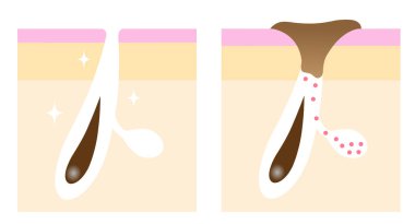 Çizimlerden önce siyah başlık gözenekleri. Yüz ve vücut bakımı kavramı.