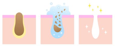 gözenek temizleyicisi siyah başlıkları açıyor. cilt bakımı öncesi ve sonrası