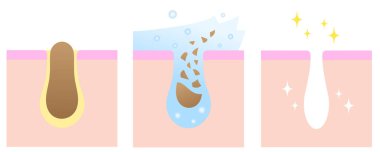 gözenek temizleyicisi siyah başlıkları açıyor. cilt bakımı öncesi ve sonrası