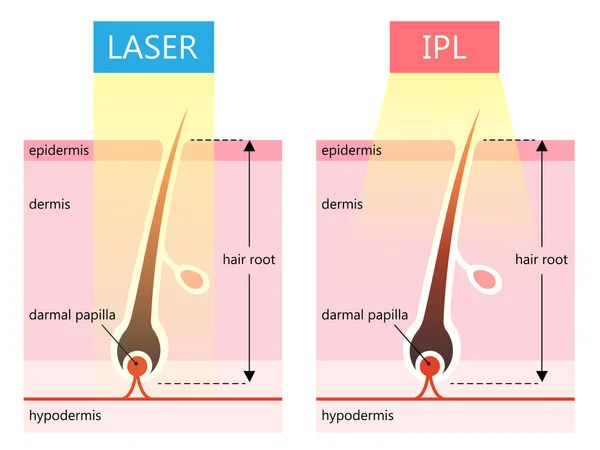 Лазерні Ipl Інтенсивне Імпульсне Світло Відмінності Видаленні Волосся Концепція Догляду — стоковий вектор