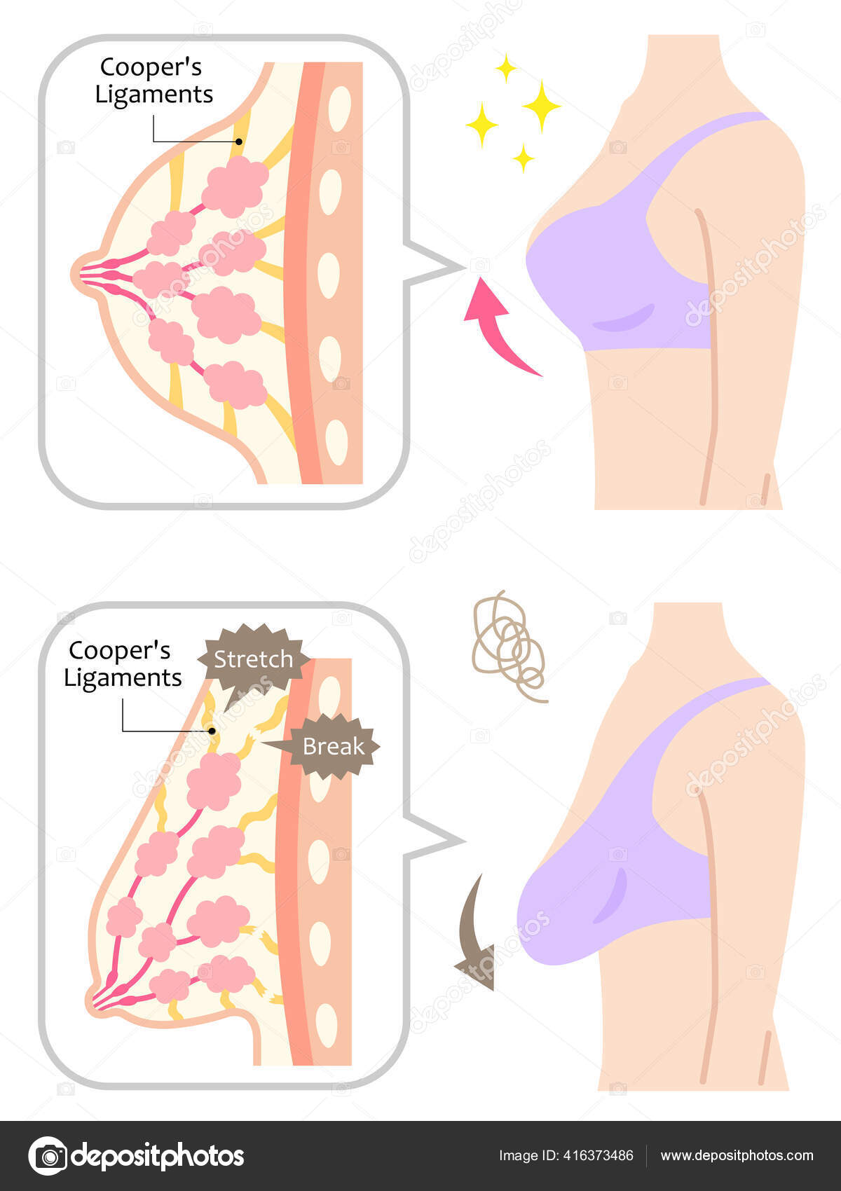 Diagram Sagging Breasts Womans Body Illustration Beauty Body Health Care  Stock Vector by ©mug5 416373486