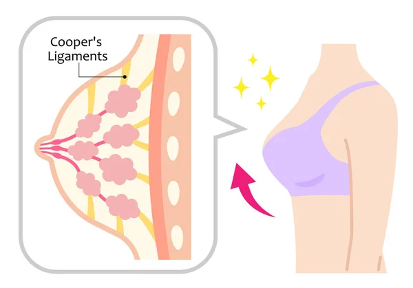 下垂的乳房和女人身体的图解 美体与保健概念 — 图库矢量图片