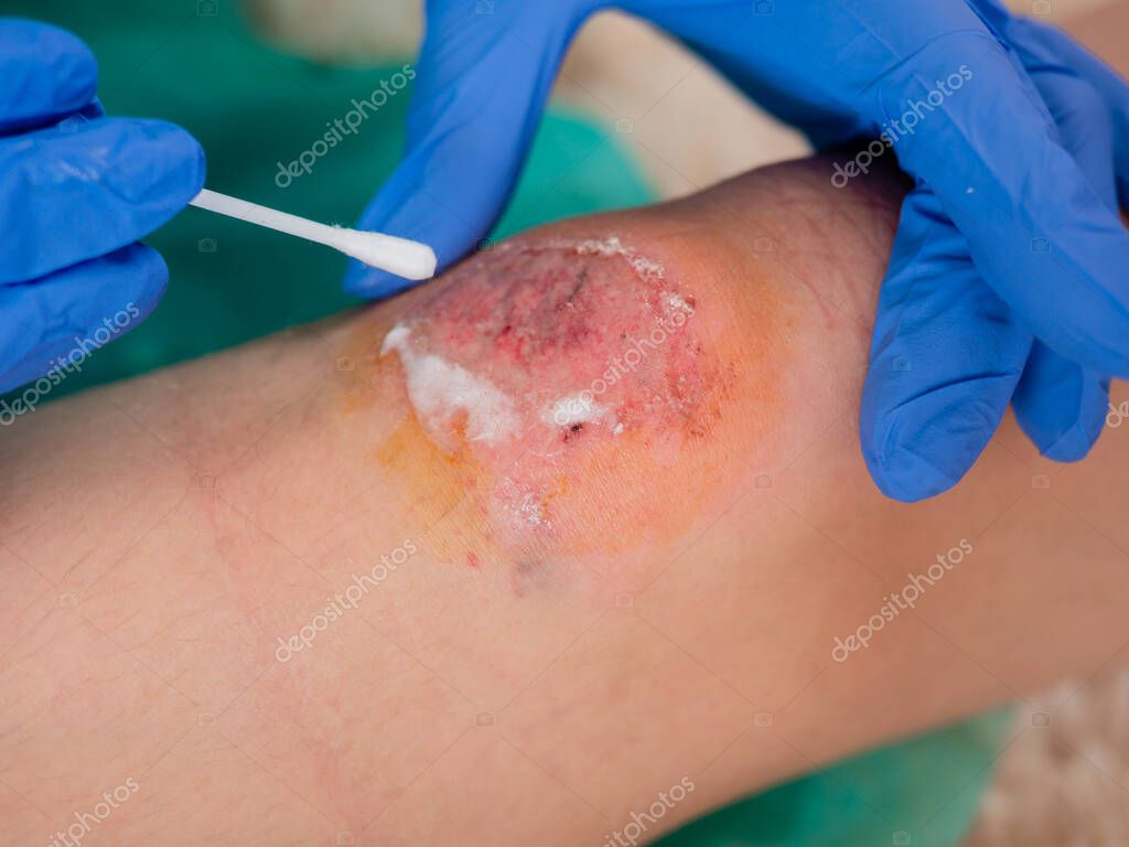 Close Up Of The Doctors Gloved Hands Using A Cotton Swab To Disinfect An Open Wound On The Patients Leg Disinfection Of A Bloody Graze On The Knee Of A Teenage Girl 384228050