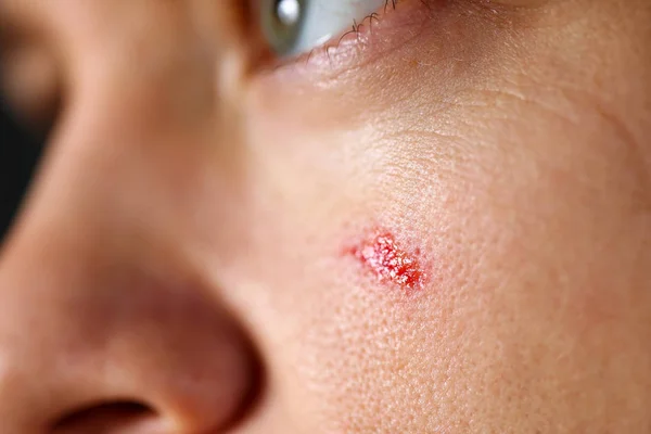 Rosto masculino com ferida na pele closeup — Fotografia de Stock