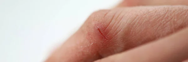 Uszkodzona skóra palca — Zdjęcie stockowe
