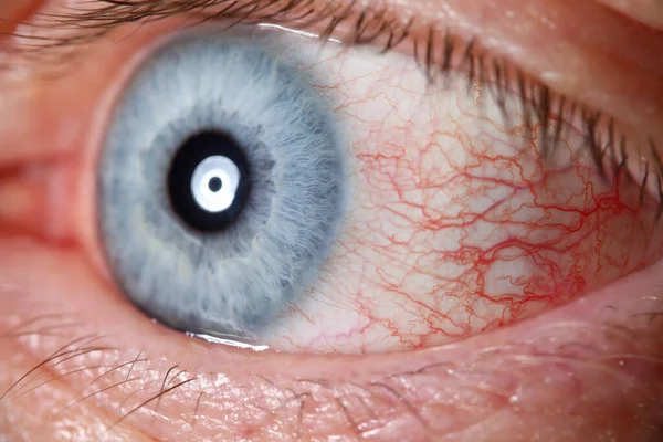 Irritado ojo azul masculino lleno de red capilar — Foto de Stock