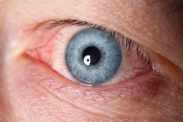 Podrážděné levé modré mužské oko plné červené kapilární sítě — Stock fotografie