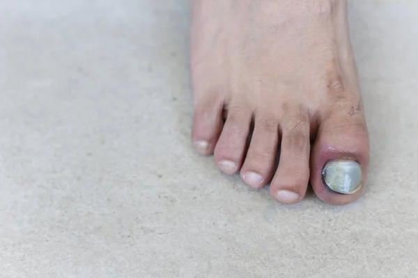 Human Male Foot Bruised Black Toe Nails — Stock Photo, Image