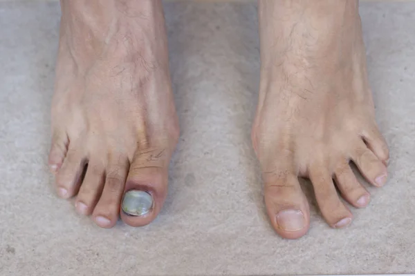 Human Male Foot Bruised Black Toe Nails — Stock Photo, Image