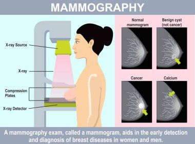 Mamografi bilgi grafikleri. Kadın meme kanseri taraması için mamografi alır. Tıbbi teknoloji ile koruma meme kanseri hakkında İllüstrasyon. Kadın meme incelemek için düşük enerjili X-ışınları kullanarak.