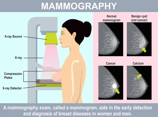 マンモグラフィーのインフォグラフィック 女性は乳癌スクリーニングのためのマンモグラムを取得します 医療技術による乳がんの保護に関するイラスト 低エネルギーX線を使用して女性の乳房を調べる — ストックベクタ