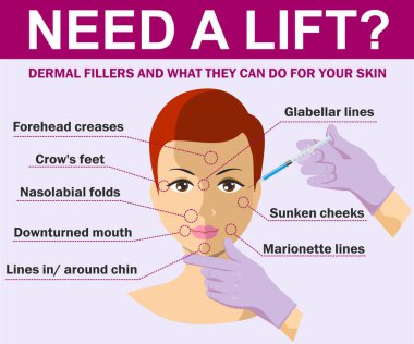 Gençleştirme kozmetik enjeksiyonları için alanlar. vektör Illustration kadın hyaluronik asit yüz enjeksiyon sahip. Vector Infographics tasarım şablonu. Güzellik, kozmetoloji, Anti-yaş