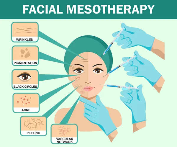 Iniezione Facciale Acido Ialuronico Modello Disegno Infografico Vettoriale Bellezza Cosmetologia — Vettoriale Stock