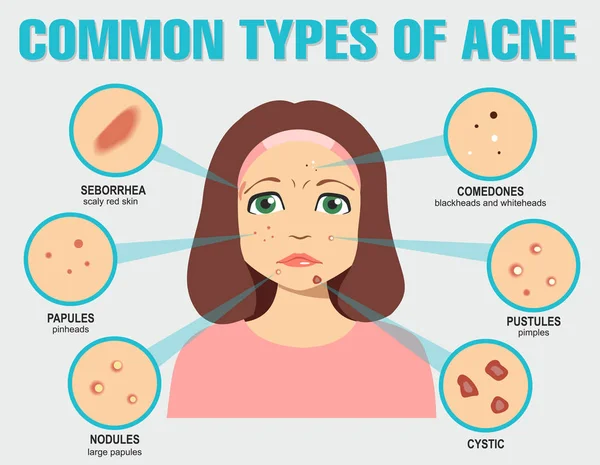 Différents Types Acné Illustration Vectorielle Avec Problèmes Peau — Image vectorielle