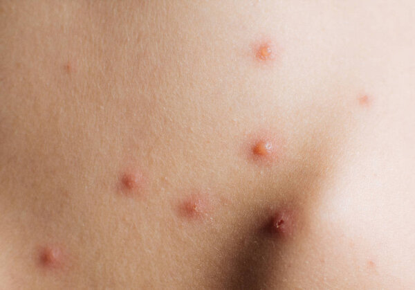 Detail baby with chicken pox rash on the back