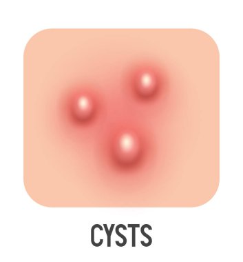 Kist vektör illüstrasyonu. Sivilce tipli. Vektör 3d clipart