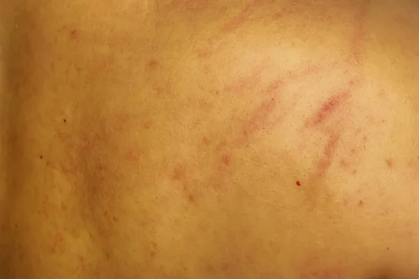 Herida Espalda Fue Causada Por Arañazos — Foto de Stock