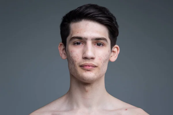 Studio portrait of a young brunette caucasian man on gray background posing. Puberty theme, problem skin, teen acne — Stock Photo, Image