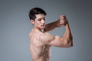 Gri arka planda stüdyo portre Genç beyaz adam poz. Ergenlik teması, problem cilt, Genç akne. Kafkas atlet Fitness. Alerji spor beslenme, takviyeleri steroidler