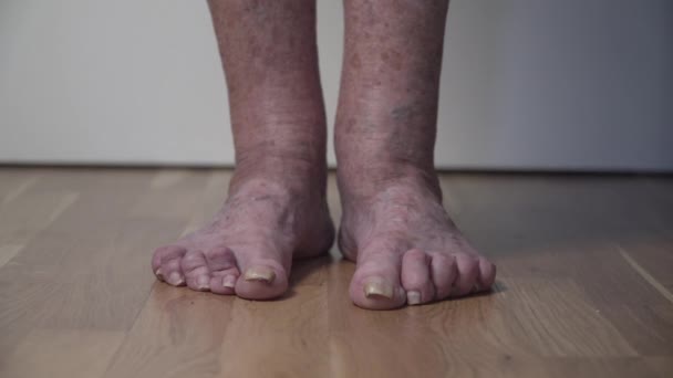 Ból paznokci u nóg zbliżenie nierozpoznawalny człowiek, starcze. Biedne kobiety ludzkie stopy wyglądają przerażająco i okropnie z długimi, nieobciętymi paznokciami. pomarszczone plamiste nogi starsza kobieta — Wideo stockowe