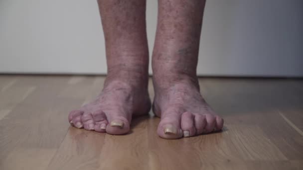 Пациентские ноги старухи. Варикозные вены на женских ногах. Флебология. Ноги старухи с изуродованными ногтями. Закрыть варикозные вены на ноге. Пожилая женщина выгрызла ногти на ногах — стоковое видео