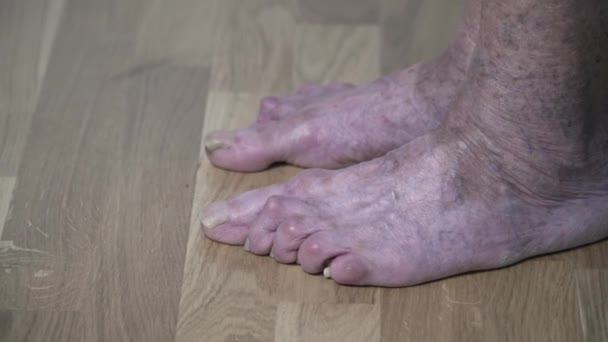 Pacientes piernas de una anciana. Venas varicosas en piernas femeninas. Flebología. Los pies de una anciana con uñas mutiladas. Cierre las venas varicosas en la pierna. La anciana desnudo uñas de los pies — Vídeos de Stock