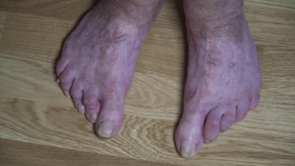 Gros plan de vieilles pieds de femmes malades avec des orteils tordus et de longs ongles effrayants. Femme âgée pieds nus avec des orteils douloureux. Grandes jambes très vieilles d'un retraité âgé non parées ongles jaunes terribles — Video