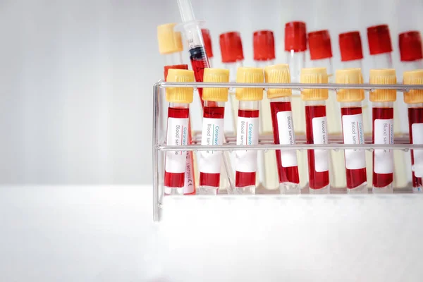 Vzorky Krve Zkumavkách Stříkačkách Pracovním Stole Laboratoři Pro Lékařské Vyšetření — Stock fotografie
