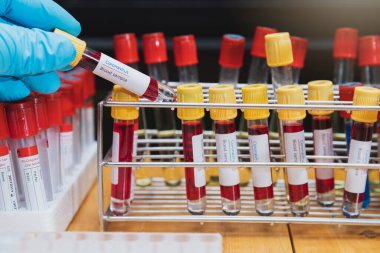Araştırmacılar kan örneklerini laboratuvarda test ediyorlar. Araştırmacılar COVID-19 virüsünü tedavi etmek için aşı icat ediyorlar..
