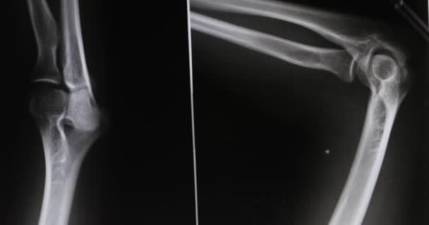 Ärzte Untersuchen Arm Beingelenke Röntgenfilm Für Analysen Medical Health Hospital — Stockvideo