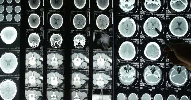 Artsen Onderzoeken Hoofd Schedel Hersenen Ray Film Voor Analysis Health — Stockvideo