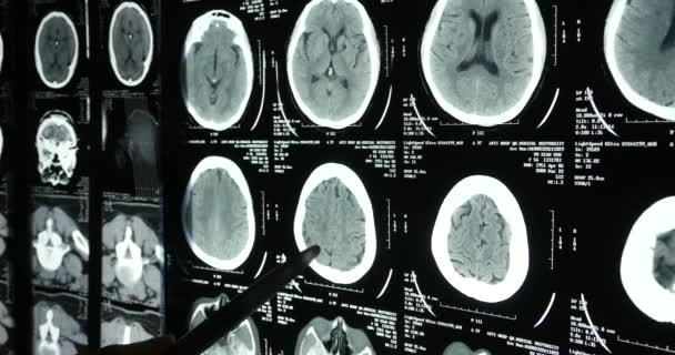 4k Врачи изучают рентгеновскую пленку мозга черепа для анализа. . — стоковое видео