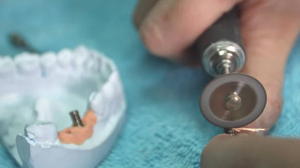 Dentysta przedstawia Model protezy z implantem — Zdjęcie stockowe
