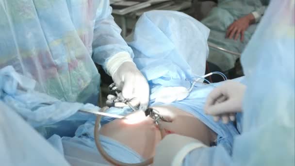 Surgery team in the operating room doing laproscopic operation — Stock Video